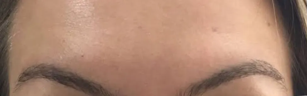A mesma testa depois do botox, com as linhas suavizadas